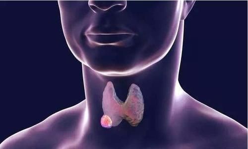 分化型|20多岁得甲状腺癌能活50年吗，医生：注意4件事，可能会活的更久