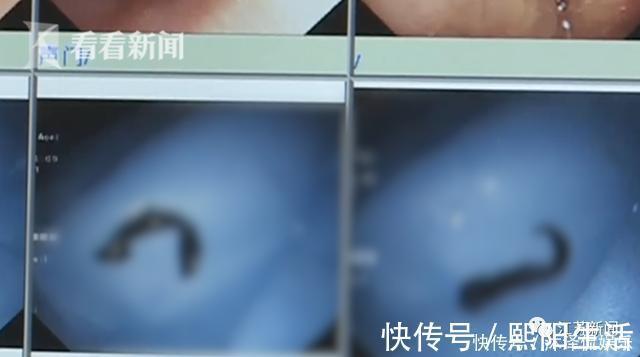 生水|女子喉咙中取出5厘米长的蚂蟥，这个习惯很多人都有