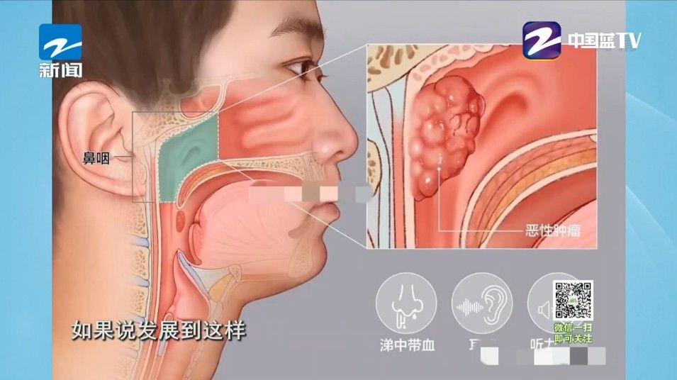 鼻出血|这种癌无声无息,一发觉就是晚期!警惕这四大征兆,早知道早救命