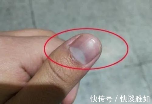 半月痕|手指甲上有月牙的人,与没有月牙的人,谁的身体更健康?