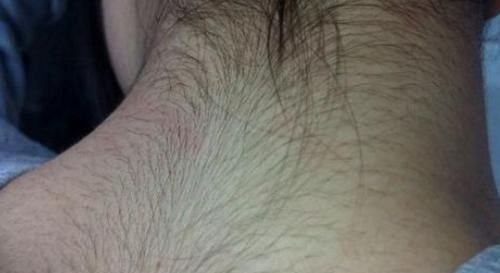 女性患有 多毛症 怎么治疗 别不好意思 3种办法让你摆脱烦恼 快资讯