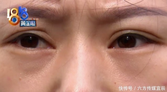 手术 女子花4万多做整形,术后鼻子凹陷讨说法,院长:你以后别照镜子