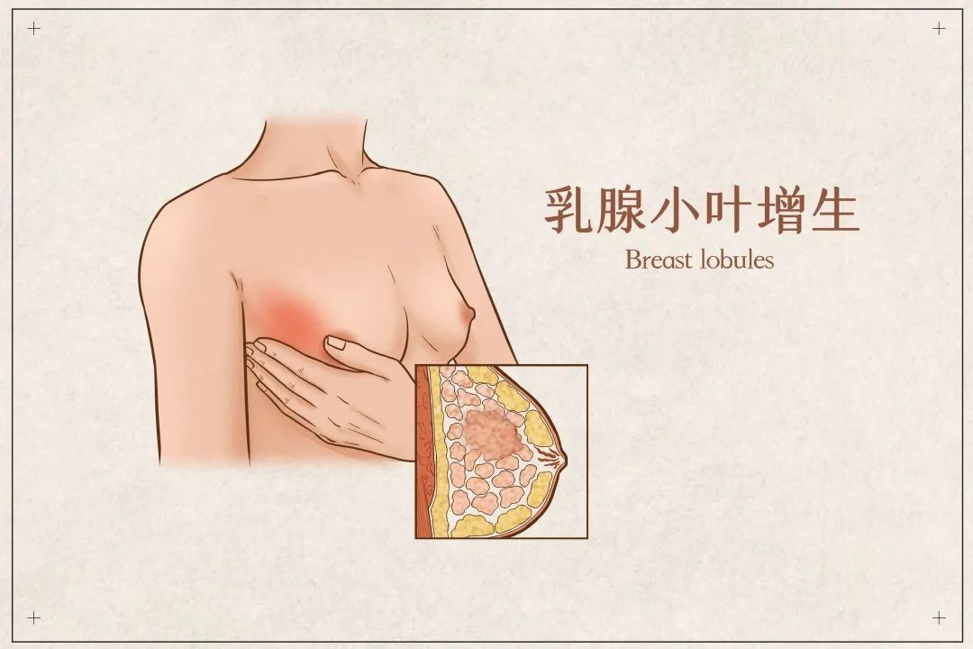 乳房|乳腺结节离癌有多远？