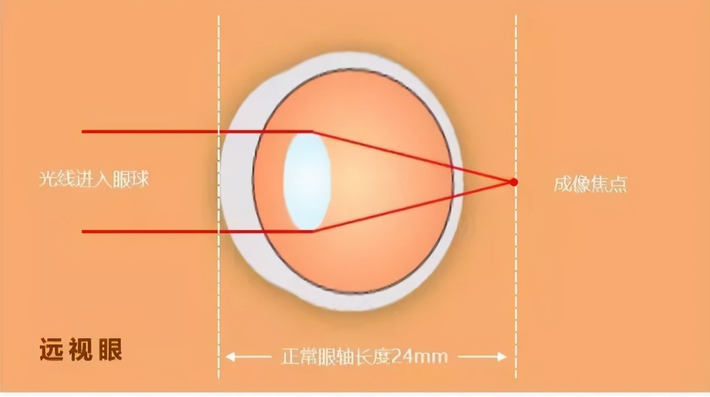  眼睛|这个数值孩子用完就会近视？