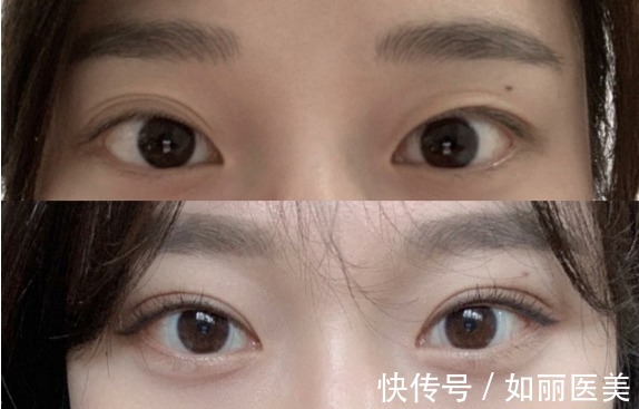 手术 双眼皮修复手术多久可以做?恢复期是多久?