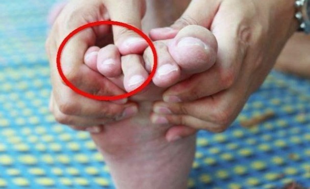 水肿|如果你的肾坏了,脚上就会有四种表现,如果没有,恭喜你肾是好的