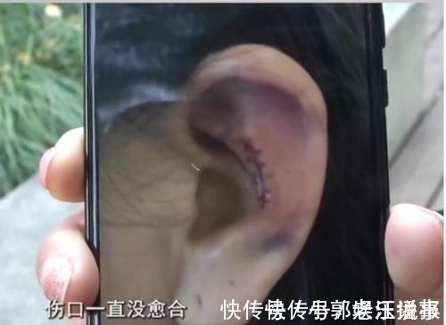 索赔 隆鼻手术后耳朵变形,十多万索赔被拒,医院:没有特别失败