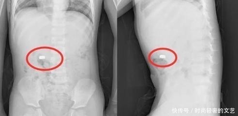 妈妈|“妈妈,我有个秘密”,听完5岁儿子的话,母亲抱着孩子冲进医院