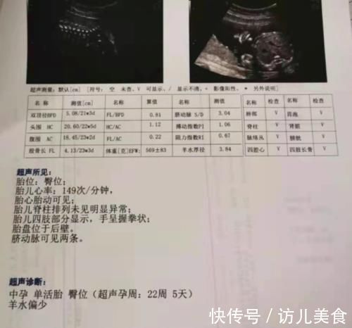 胎位|孕期做几次B超?各B超单信息代表什么?孕妈要搞清楚
