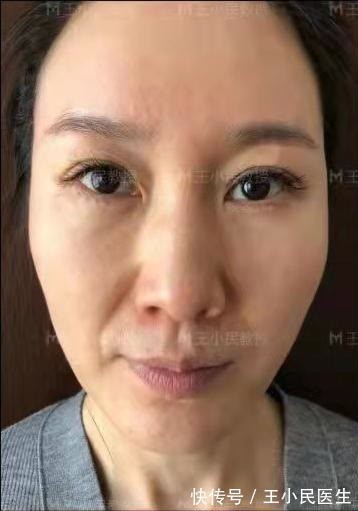 法令纹 拉皮除皱王小民教授:46岁的她选择了小拉皮手术,看看效果反馈!