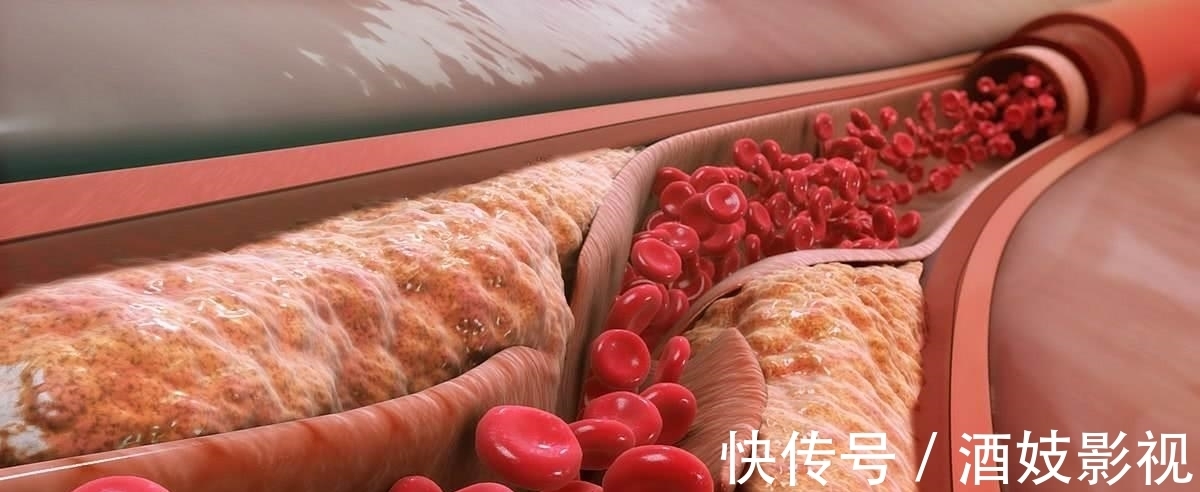 高血脂|橘子是高血脂的“催化剂”?心血管医生:这三种水果,别贪吃