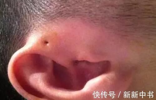 沙土堆|你家宝宝耳朵上有“富贵洞”吗?如果有,家长们可要多留心了