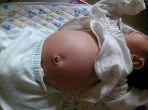 紫红色|6个月女宝肚子胀得像怀孕,家人赶紧送医院,医生:还好来得及时