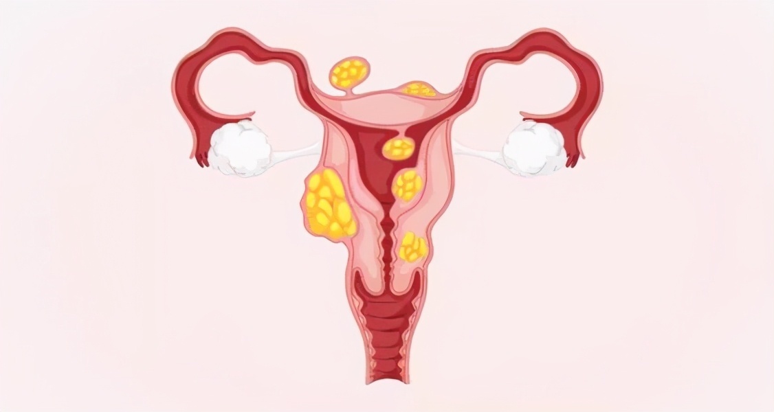 张女士|神奇的桂枝茯苓丸,治好了困扰多年的子宫肌瘤