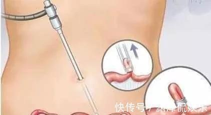 丈夫们|生完后是“上环”好还是“结扎”好医生讲出实话,很多人选错了