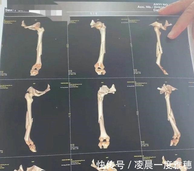 瑜伽|女子练瑜伽被教练压断大腿!网友下手太狠了!