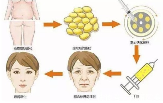填充 面部填充脂肪多长时间能恢复自然状态?价格&术后攻略送你参考!
