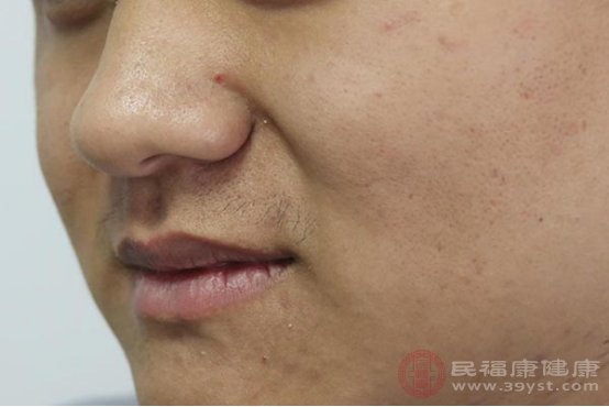 怎么去掉粉刺黑头