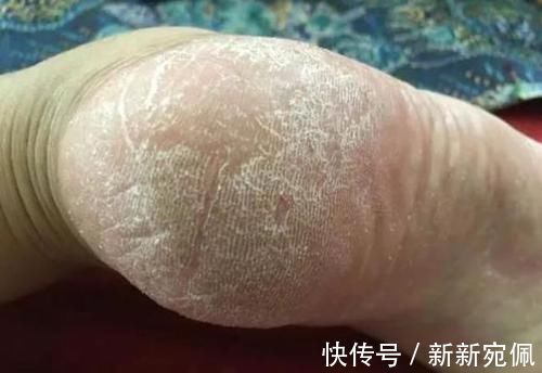 维生素|脚后跟总是干裂起皮?可能是体内疾病发出的信号,别忽视!