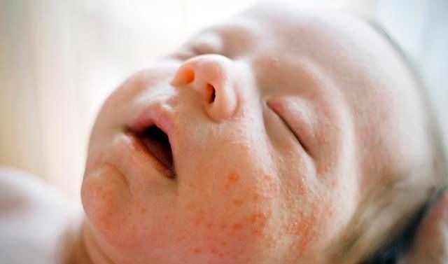 药物|婴儿得了湿疹就不能洗澡?错,关于它的5大谣言要认清,别再上当了