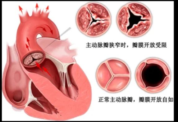 脑梗死|北京同仁医院心血管中心完成医院首例经导管主动脉瓣置换术