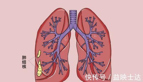 肺结核|做肺部CT时,发现阴影是不是肺内有癌了?医生:还有3个可能