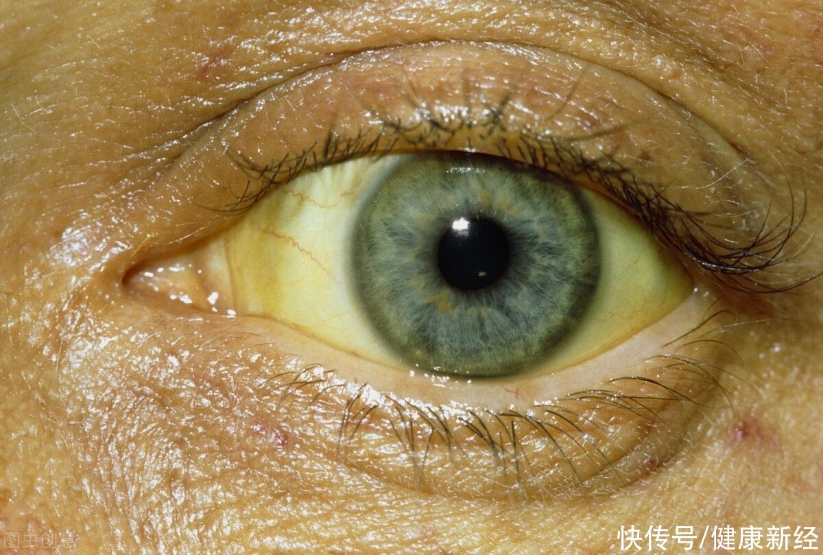 肝气郁结|肝炎恶化，有4种异常，要及时观察，做到早发现早治疗