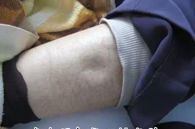 中度水肿|一个很奇效的方子，服用一周，全身的水肿和积液全不见了