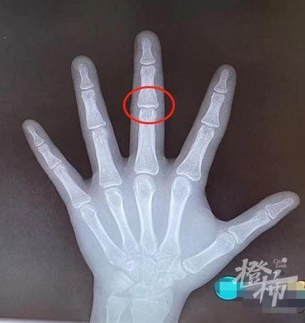 发育|暑假“测骨龄”的娃乌泱泱!儿科专家提醒:要小心