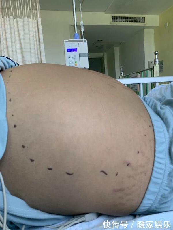 囊肿|13岁女生肚子隆起爬满“妊娠纹”,照完CT妈妈当场吓懵