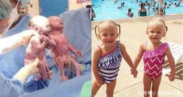 输卵管|双胞胎“手牵手”一起出生，画面瞬间感动医生，真的是太有爱了！