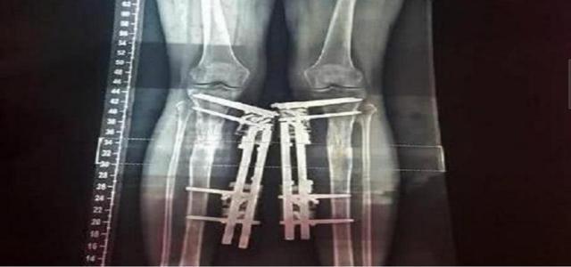 现状|花400多万做200次整容手术的“红粉宝宝”,现状让令人唏嘘