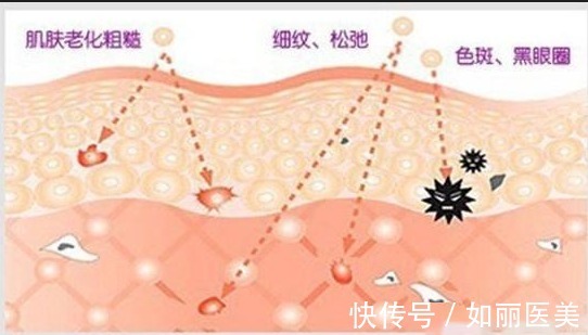 如果爱 深扒!超光子和光子嫩肤的区别,你更适合哪一种呢?