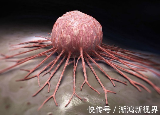 大夫|癌症会提前告知你4个征兆,大夫提醒此3个部位最好每年检查1次