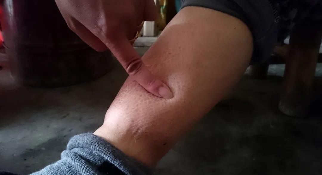 天然溶栓“高手”发现了,日常坚持喝,软化血管,清血管化血栓