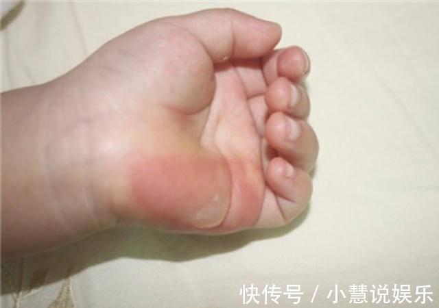 常识|孩子烫出水泡,要不要刺破烫伤高发期,基本急救常识要知道