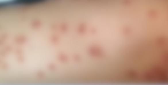 荨麻疹|女子一觉醒来，身上出现密密麻麻红疹！和家里这种东西有关