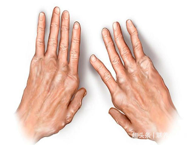 腰腿|一个千古止痛名方,6味药,腰不突了,腿不痛了,老风湿也拜拜了