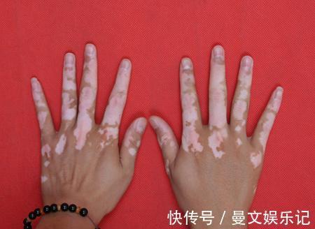 血管瘤|要想宝宝出生后不长胎记,孕期避免这几件事就OK,你做到了几条