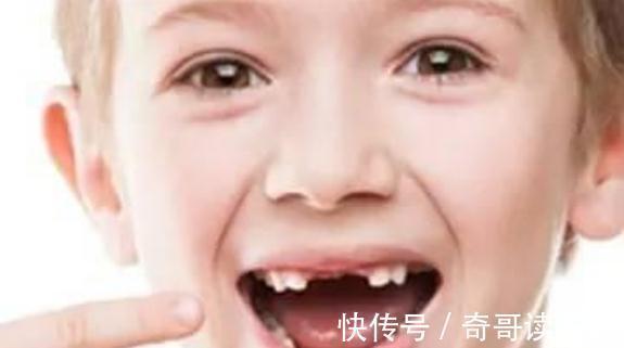牙齿|孩子6岁乳牙不掉，长成“双排牙”，和遗传无关，原因在家长身上