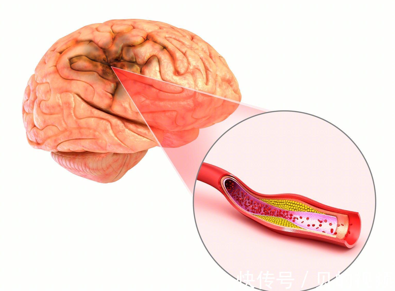 窦房结|房颤,让卒中风险高3—5倍!医生教你如何正确对待