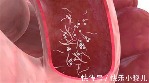 感染率|2岁女儿患上“蛲虫病”,得知原因后,宝妈直接气得带孩子回娘家