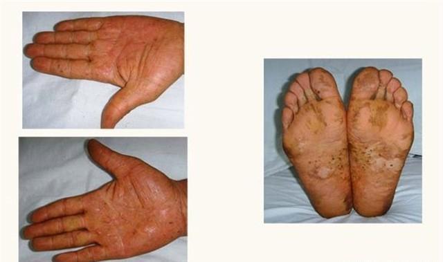 真菌|“脚气”真菌怎么做才能根除?2个简单小方法,彻底治好不复发!