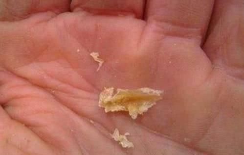 耳屎|为什么耳朵总是发痒,却掏不出耳屎很有可能是一种东西在作怪