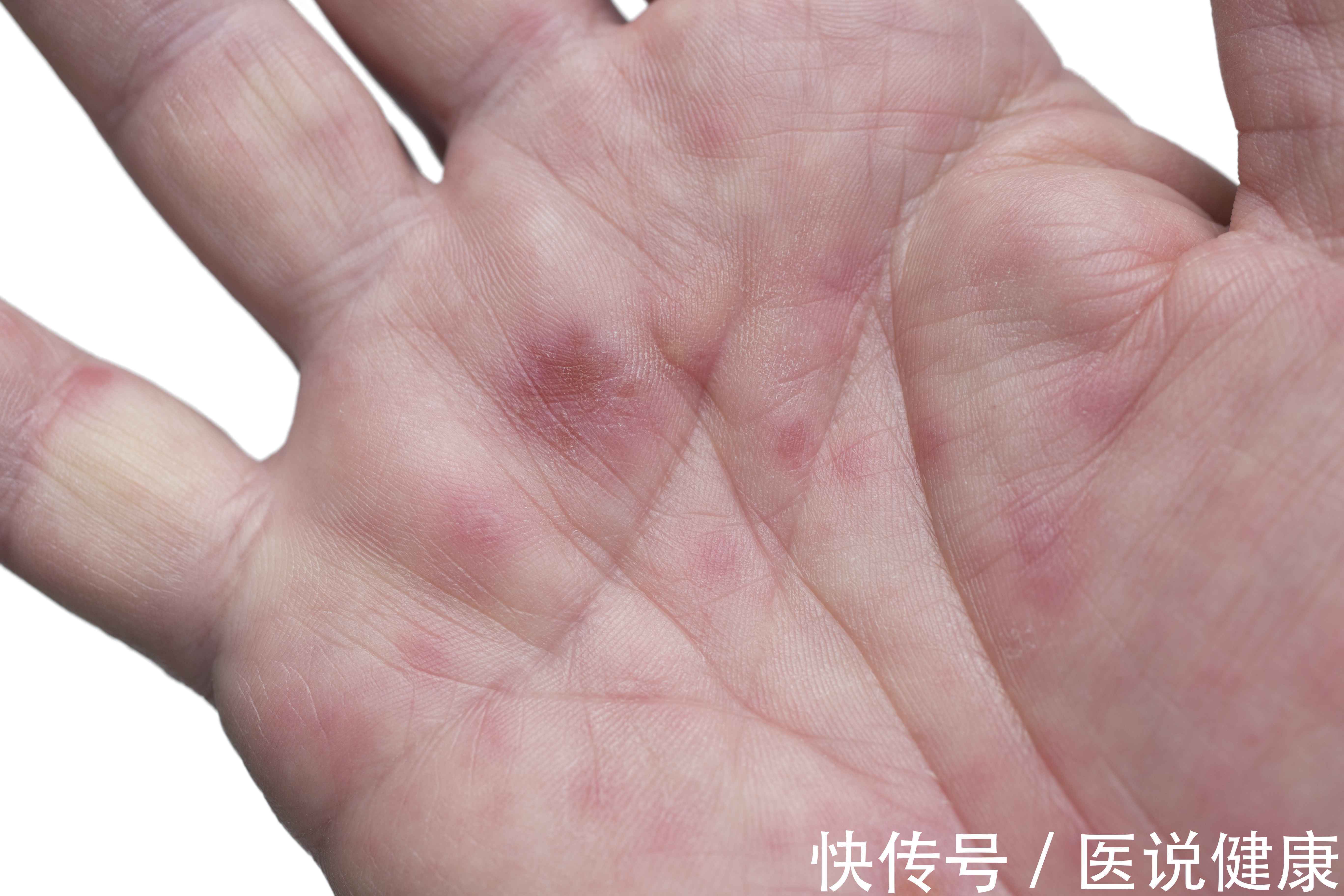 饮酒|喝酒后,身体有这5种情况,或是肝脏在向你球了,要及时戒酒