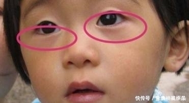 孩子|孩子积食脾虚,小脸先知!脸部这4个异常,若占一个,家长需上心