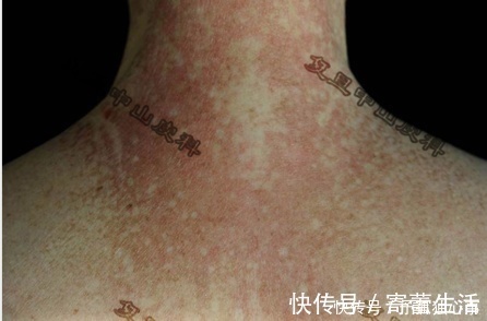 皮肤科|救命药让肿瘤消失了，却引发另一种致命病