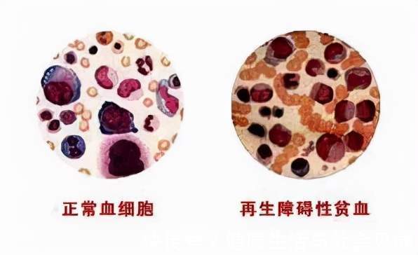 乏力|频繁头晕、乏力可能是贫血!谢别录:贫血有很多种,看你是哪一种