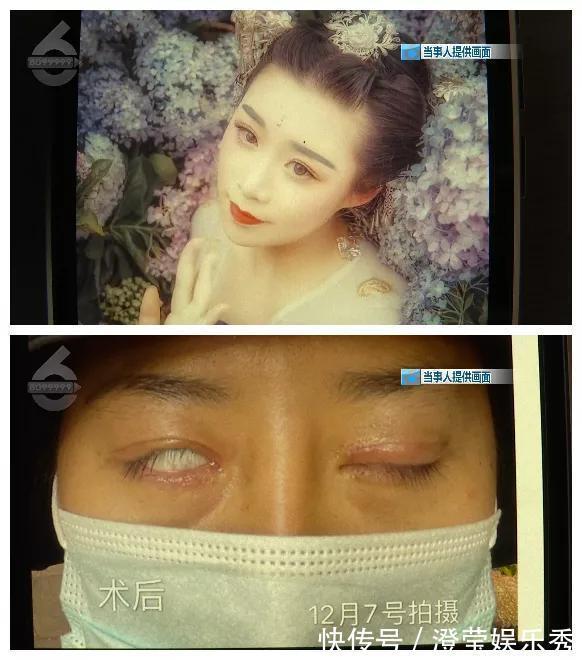 右眼|比原来丑这么多!女子花钱整成“阿凡达”眼睛都闭不上:“昨晚又是一夜没睡”