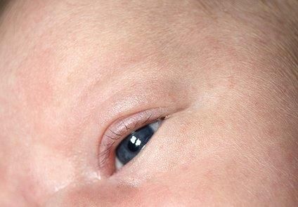 沙眼跟遗传还是感染有关系呢？